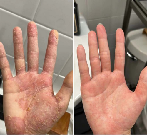 Krém na zápal pleti & zdravá pleť – Uľavuje od svrbenia, začervenania a šúpanie 50ml photo review